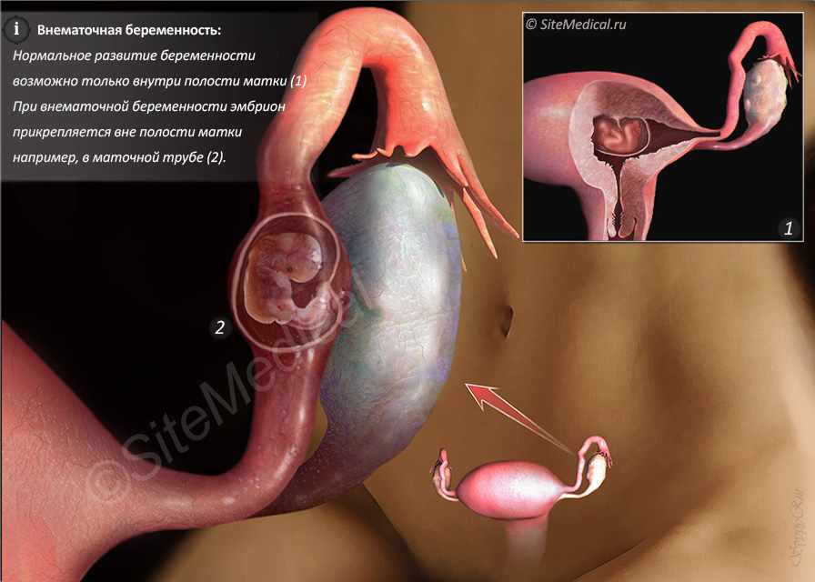 внематочной При беременности зародыш не женщины развитие беременности во